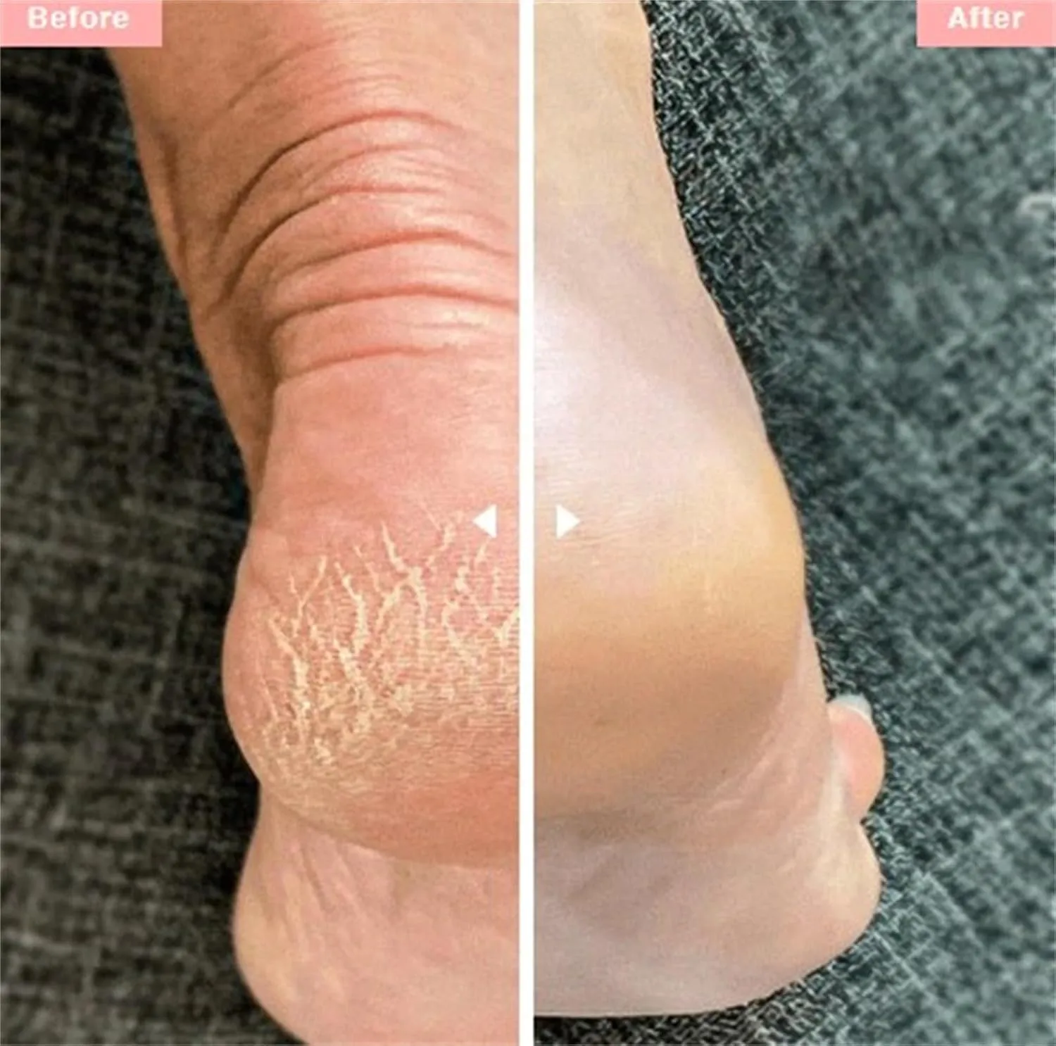 Laenia Nanoglass Foot File, Laenia Foot File, Glass Foot File, Nano Glass Foot File, Glass Foot File Callus Remover, Foot File for Dead Skin, Foot Scrubber Dead Skin Remover (B E)